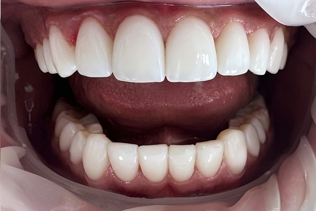 Case 03, After